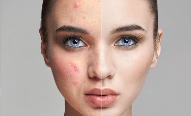tratamiento-acne-pamplona-626x380